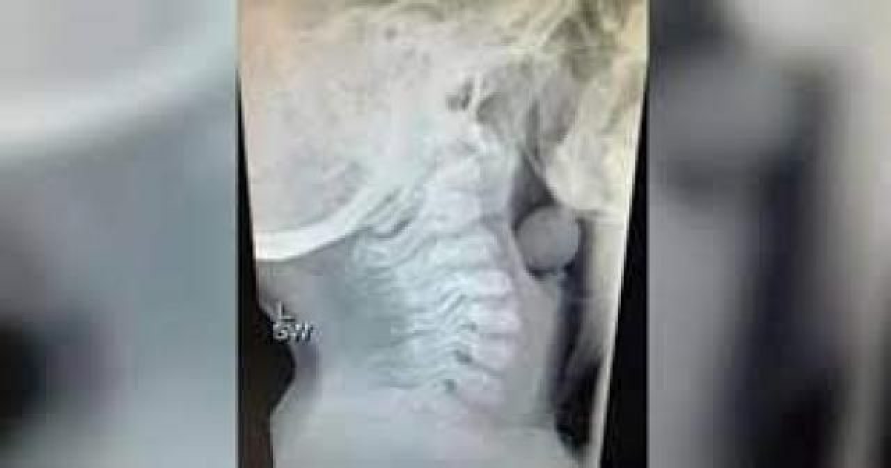 Boğulma tehlikesine karşı ebeveynleri uyaran anne: Çocuklarınıza üzüm vermeyin 1