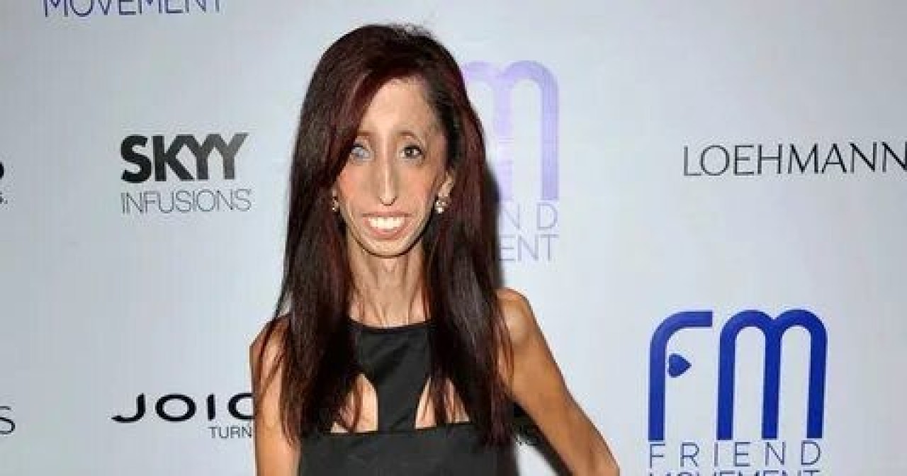 Lizzie velasquez: Dünyanın en çirkin kadını değil, en cesur kadını... 3
