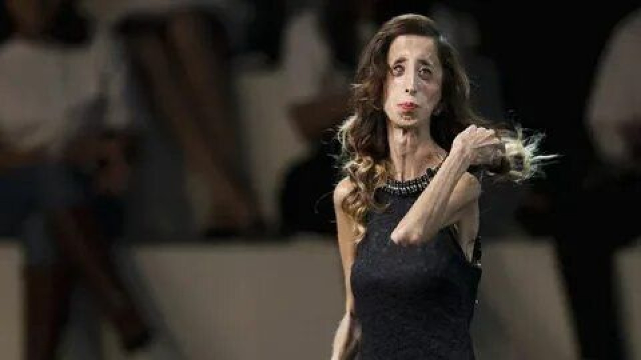 Lizzie velasquez: Dünyanın en çirkin kadını değil, en cesur kadını... 2