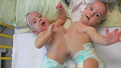 Ankara'da Nadir Görülen Bir Olay Siyam İkizleri Dünyaya Geldi! Doktorlar yeni doğan bebeği görünce..