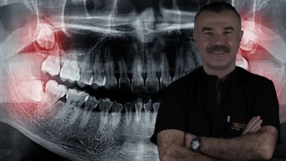 Uzman Diş Hekimi Uyardı: Yirmilik Dişler İhmale Gelmiyor, Gülüşünüz Bozulabilir