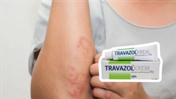 Travazol krem: mantar,  egzama ve pişik sorunlarına karşı etkili bir çözüm! Mucizevi etki bir arada