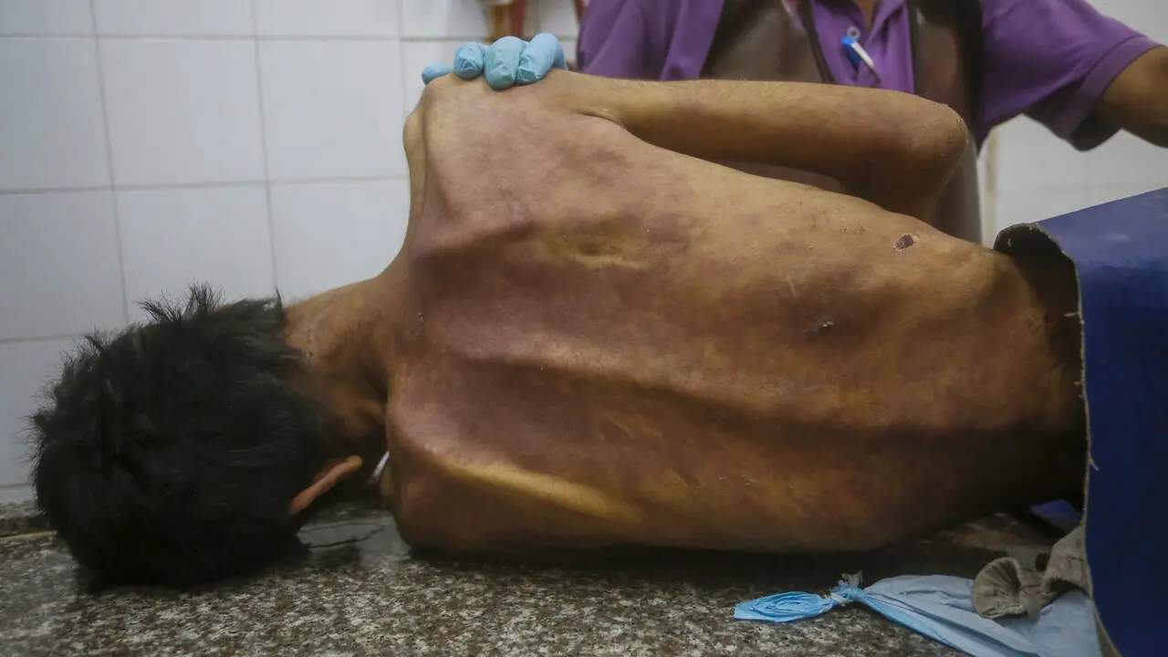 Yetersiz Beslenmeden Can Kaybı 422’ye Yükseldi