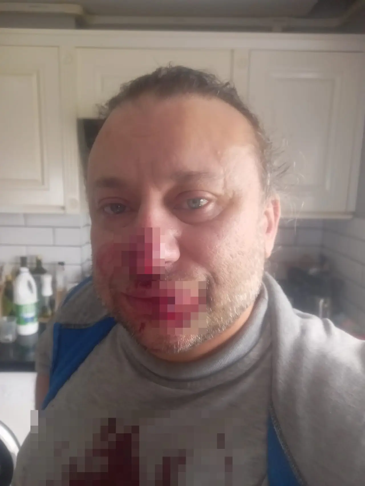 Onur Akay Pitbull Saldırısına Uğradı Et Yiyen Bakteri Entübe Ettirdi